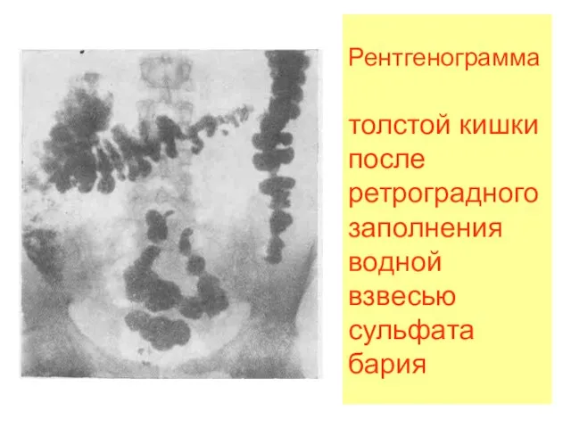 Рентгенограмма толстой кишки после ретроградного заполнения водной взвесью сульфата бария