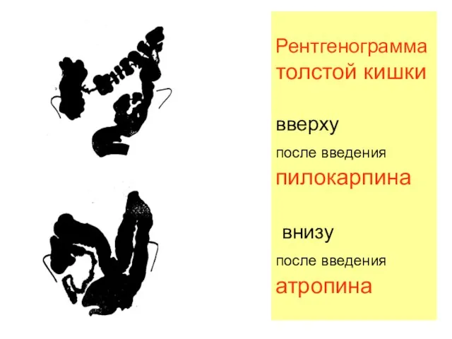 Рентгенограмма толстой кишки вверху после введения пилокарпина внизу после введения атропина