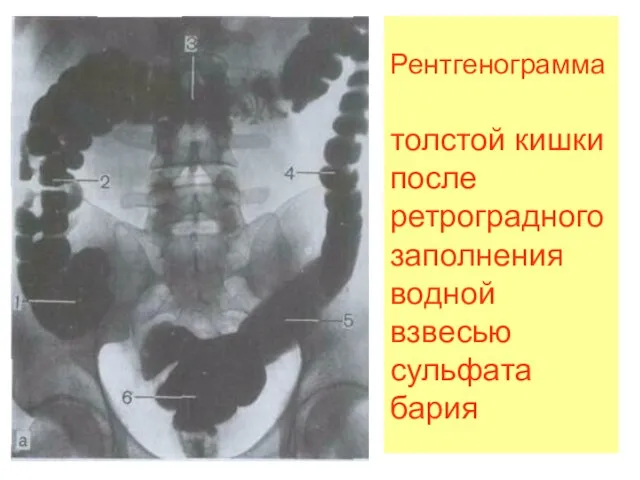 Рентгенограмма толстой кишки после ретроградного заполнения водной взвесью сульфата бария