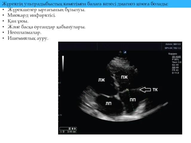 Жүректің ультрадыбыстық көмегімен балаға келесі диагноз қоюға болады: Жүрекшелер ырғағының бұзылуы. Миокард