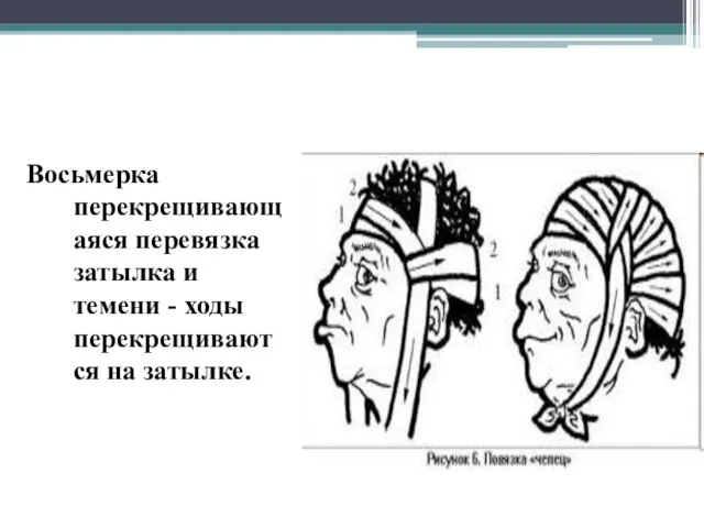 Восьмерка перекрещивающаяся перевязка затылка и темени - ходы перекрещиваются на затылке.