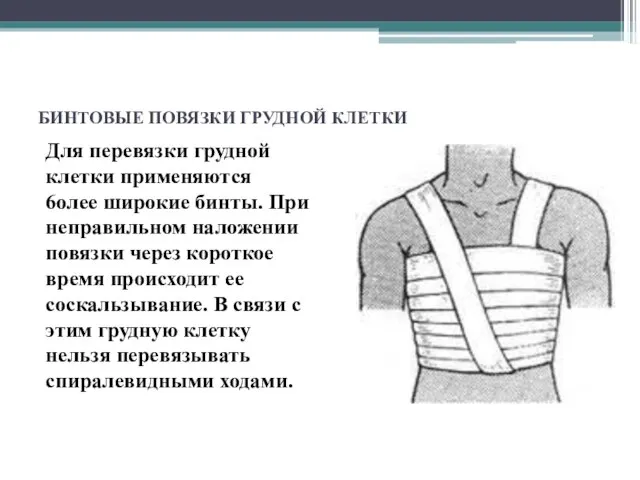 БИНТОВЫЕ ПОВЯЗКИ ГРУДНОЙ КЛЕТКИ Для перевязки грудной клетки применяются 6олее широкие бинты.