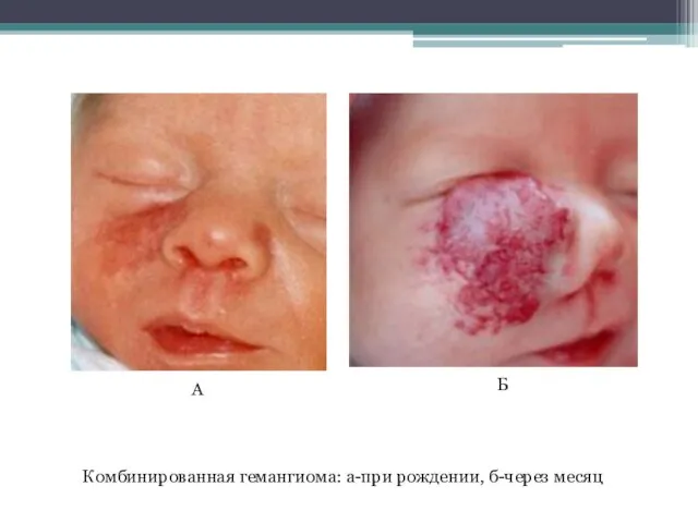 Комбинированная гемангиома: а-при рождении, б-через месяц А Б