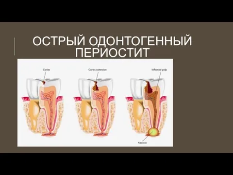 ОСТРЫЙ ОДОНТОГЕННЫЙ ПЕРИОСТИТ