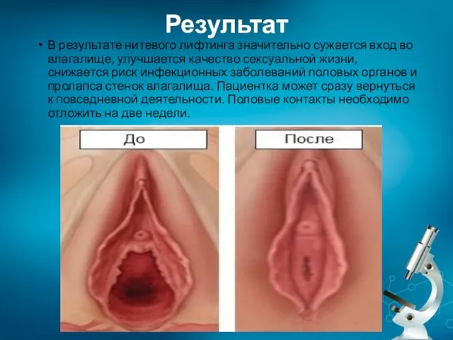 Результат В результате нитевого лифтинга значительно сужается вход во влагалище, улучшается качество