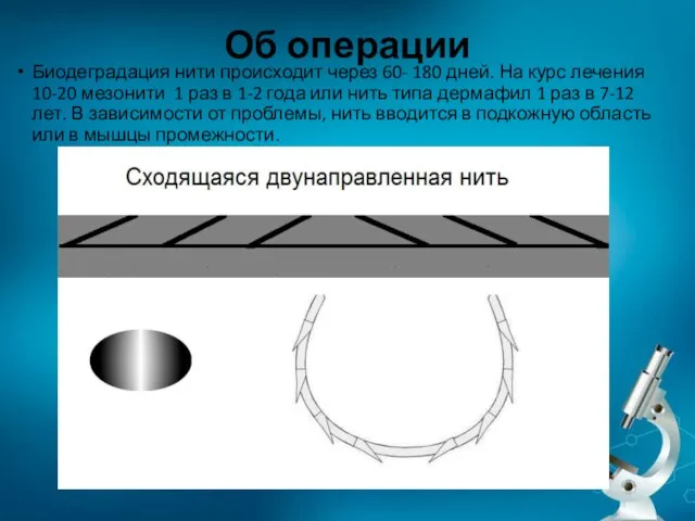 Об операции Биодеградация нити происходит через 60- 180 дней. На курс лечения