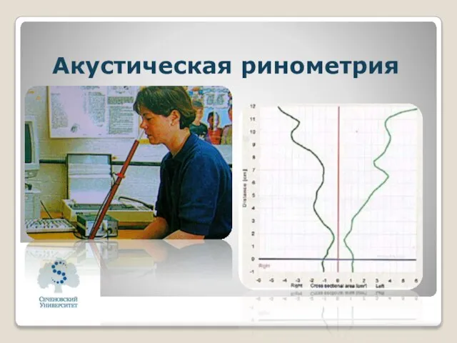 Акустическая ринометрия