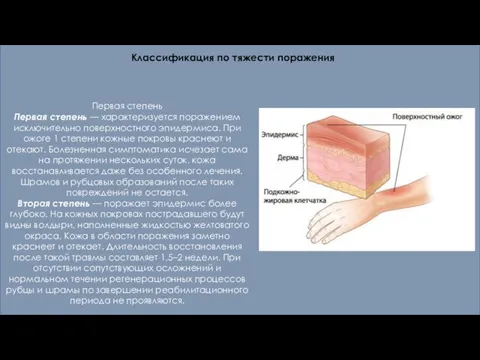 Первая степень Первая степень — характеризуется поражением исключительно поверхностного эпидермиса. При ожоге