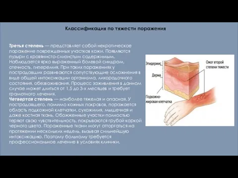 Классификация по тяжести поражения Третья степень — представляет собой некротическое поражение поврежденных