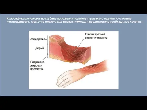 Классификация ожогов по глубине поражения позволяет правильно оценить состояние пострадавшего, грамотно оказать