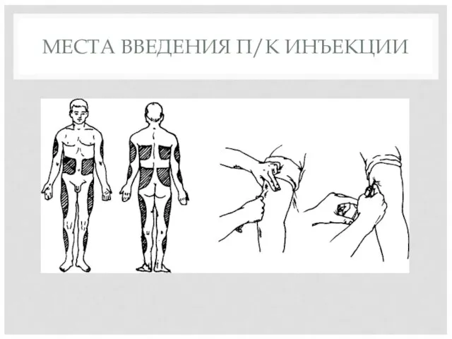 МЕСТА ВВЕДЕНИЯ П/К ИНЪЕКЦИИ