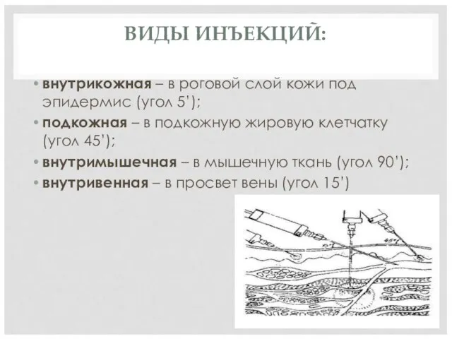 ВИДЫ ИНЪЕКЦИЙ: внутрикожная – в роговой слой кожи под эпидермис (угол 5’);