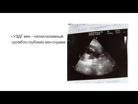 УЗДГ вен – неокклюзивный тромбоз глубоких вен справа