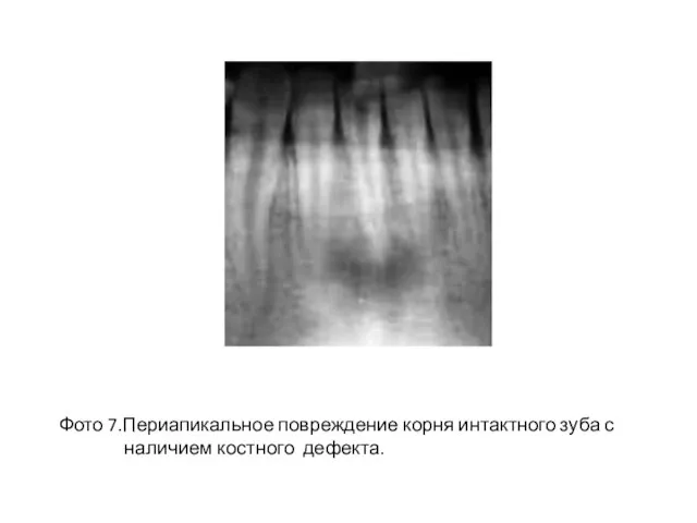 Фото 7.Периапикальное повреждение корня интактного зуба с наличием костного дефекта.