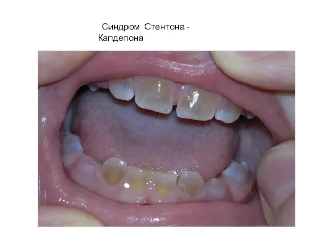 Синдром Стентона - Капдепона