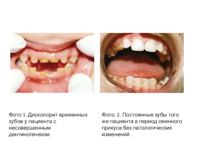 Фото 1. Дисколорит временных зубов у пациента с несовершенным дентиногенезом. Фото 2.