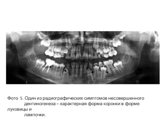 Фото 5. Один из радиографических симптомов несовершенного дентиногенеза – характерная форма коронки