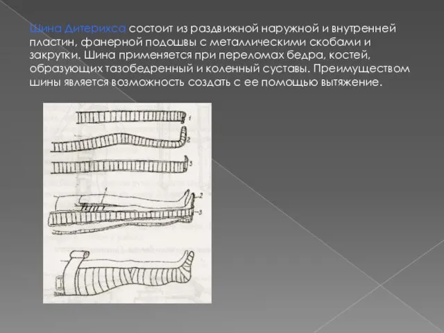 Шина Дитерихса состоит из раздвижной наружной и внутренней пластин, фанерной подошвы с