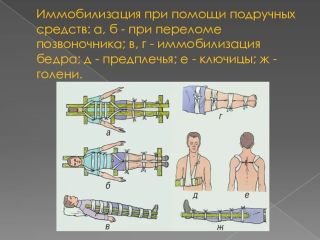 Иммобилизация при помощи подручных средств: а, б - при переломе позвоночника; в,