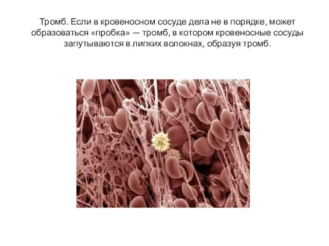 Тромб. Если в кровеносном сосуде дела не в порядке, может образоваться «пробка»