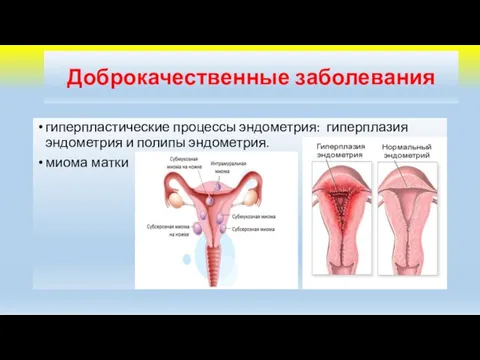 Доброкачественные заболевания гиперпластические процессы эндометрия: гиперплазия эндометрия и полипы эндометрия. миома матки