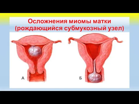 Осложнения миомы матки (рождающийся субмукозный узел)
