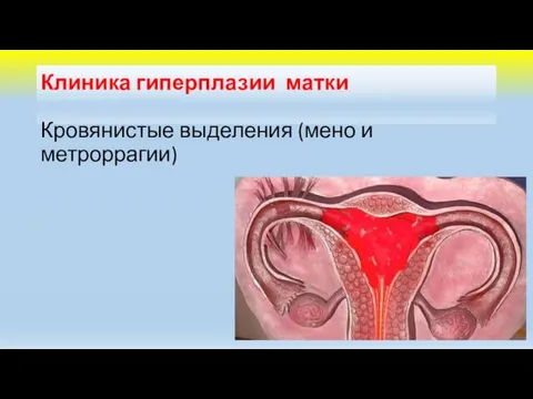 Клиника гиперплазии матки Кровянистые выделения (мено и метроррагии)