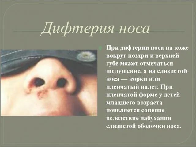 Дифтерия носа При дифтерии носа на коже вокруг ноздри и верхней губе