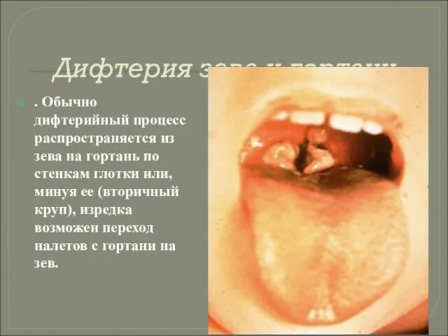 Дифтерия зева и гортани . Обычно дифтерийный процесс распространяется из зева на