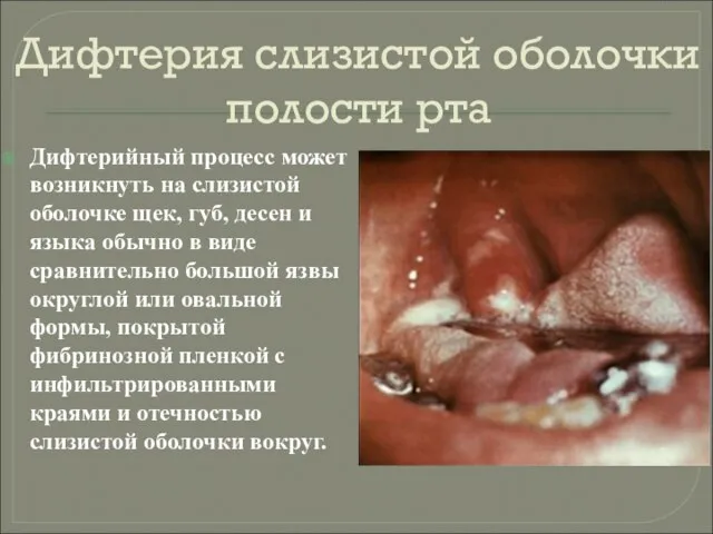 Дифтерия слизистой оболочки полости рта Дифтерийный процесс может возникнуть на слизистой оболочке