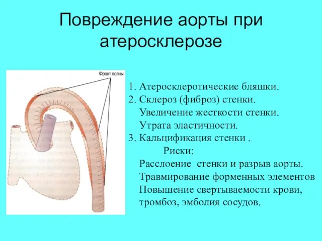 Повреждение аорты при атеросклерозе 1. Атеросклеротические бляшки. 2. Склероз (фиброз) стенки. Увеличение