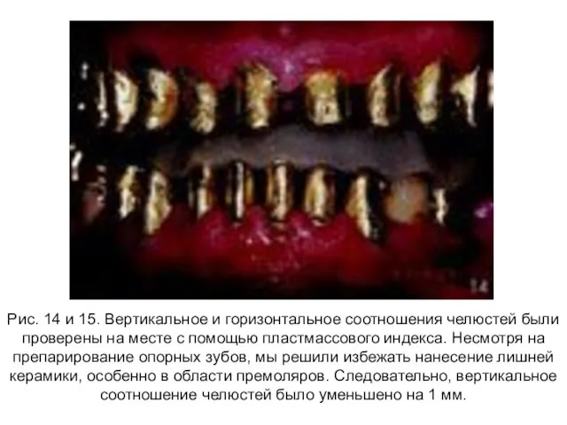 Рис. 14 и 15. Вертикальное и горизонтальное соотношения челюстей были проверены на