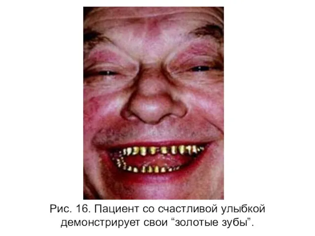 Рис. 16. Пациент со счастливой улыбкой демонстрирует свои “золотые зубы”.