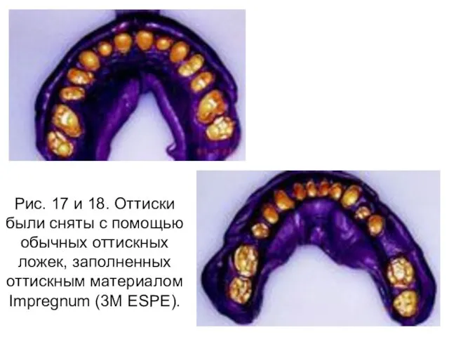 Рис. 17 и 18. Оттиски были сняты с помощью обычных оттискных ложек,