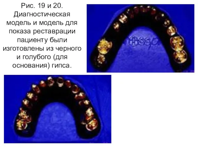 Рис. 19 и 20. Диагностическая модель и модель для показа реставрации пациенту