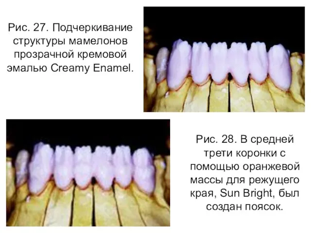 Рис. 27. Подчеркивание структуры мамелонов прозрачной кремовой эмалью Creamy Enamel. Рис. 28.