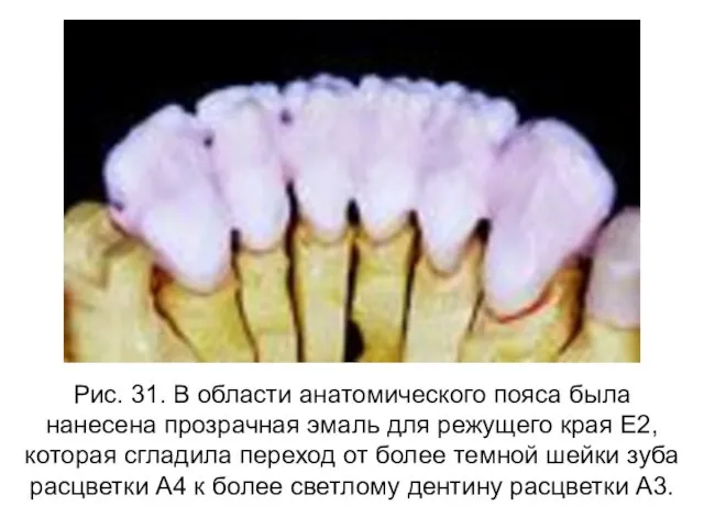 Рис. 31. В области анатомического пояса была нанесена прозрачная эмаль для режущего