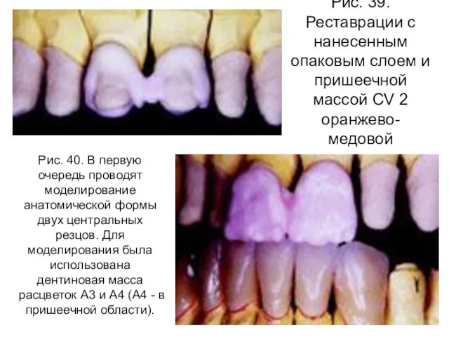 Рис. 39. Реставрации с нанесенным опаковым слоем и пришеечной массой CV 2