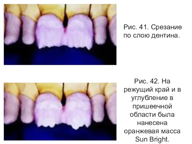 Рис. 41. Срезание по слою дентина. Рис. 42. На режущий край и