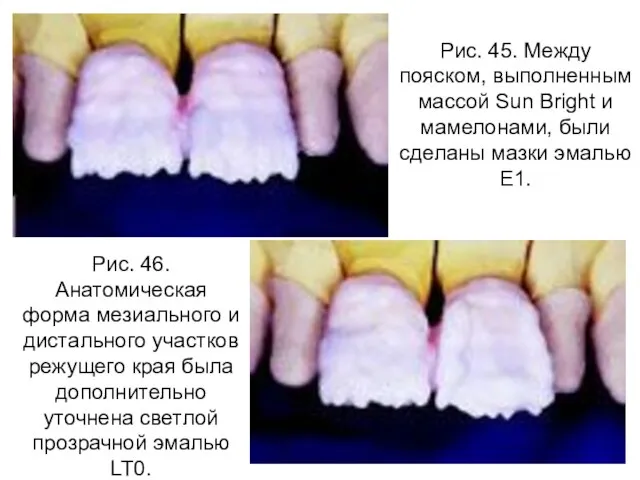 Рис. 45. Между пояском, выполненным массой Sun Bright и мамелонами, были сделаны