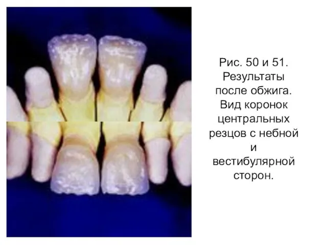 Рис. 50 и 51. Результаты после обжига. Вид коронок центральных резцов с небной и вестибулярной сторон.