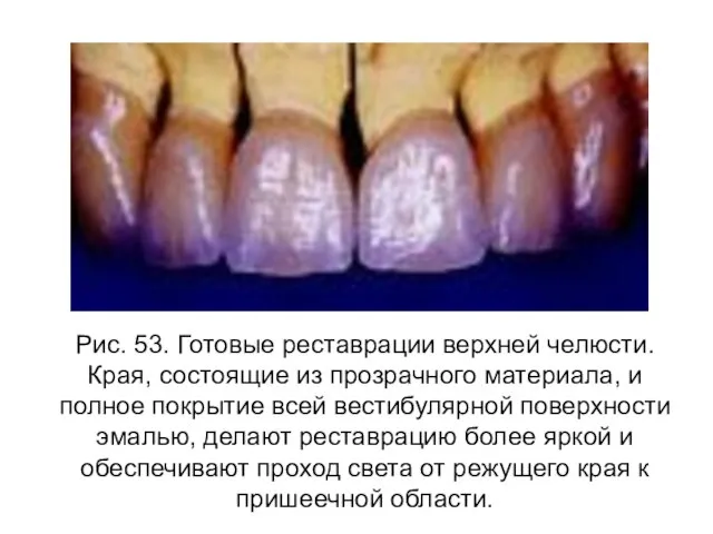 Рис. 53. Готовые реставрации верхней челюсти. Края, состоящие из прозрачного материала, и