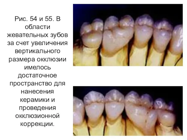 Рис. 54 и 55. В области жевательных зубов за счет увеличения вертикального