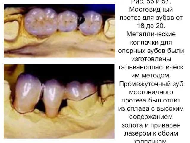 Рис. 56 и 57. Мостовидный протез для зубов от 18 до 20.