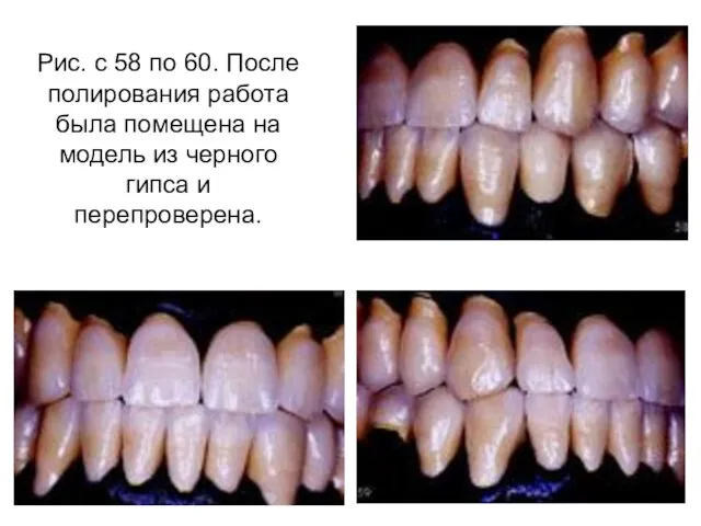 Рис. с 58 по 60. После полирования работа была помещена на модель