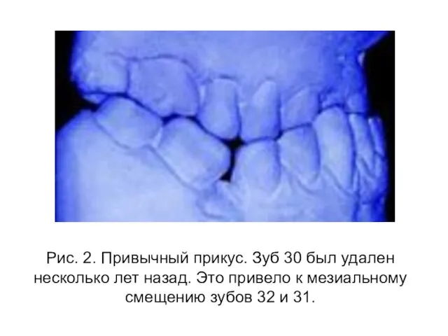 Рис. 2. Привычный прикус. Зуб 30 был удален несколько лет назад. Это