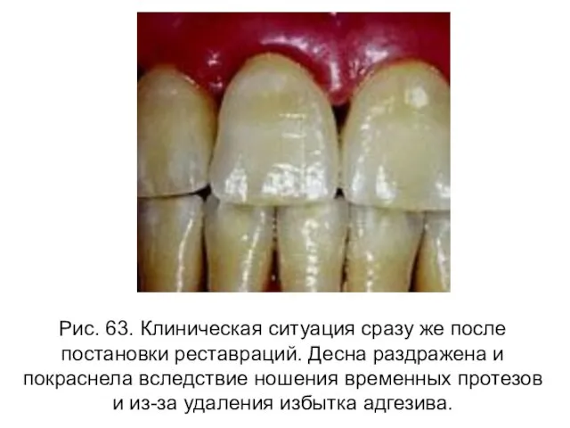 Рис. 63. Клиническая ситуация сразу же после постановки реставраций. Десна раздражена и