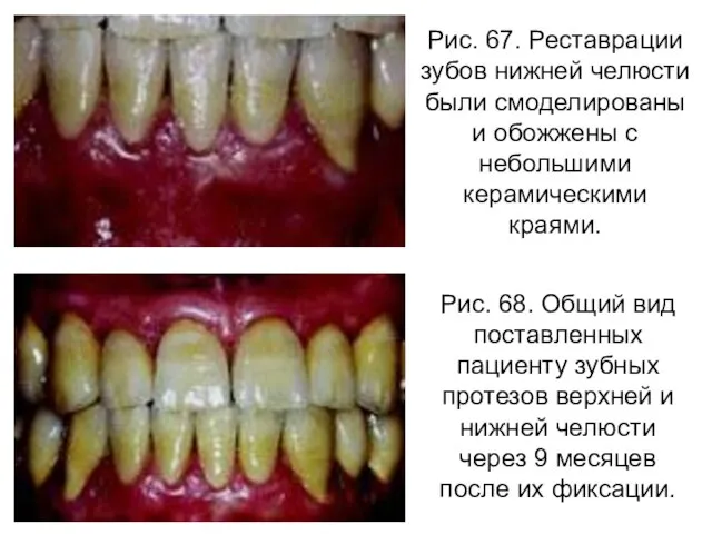 Рис. 67. Реставрации зубов нижней челюсти были смоделированы и обожжены с небольшими