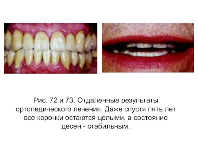 Рис. 72 и 73. Отдаленные результаты ортопедического лечения. Даже спустя пять лет