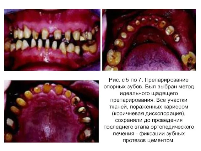 Рис. с 5 по 7. Препарирование опорных зубов. Был выбран метод идеального